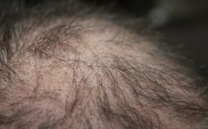men baldness